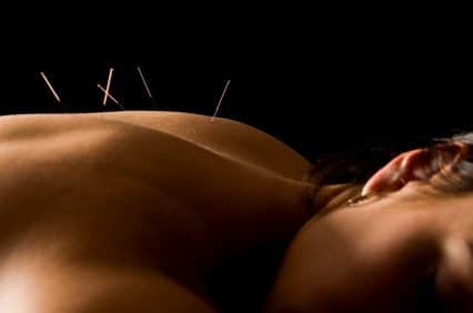 acupuncture needles.