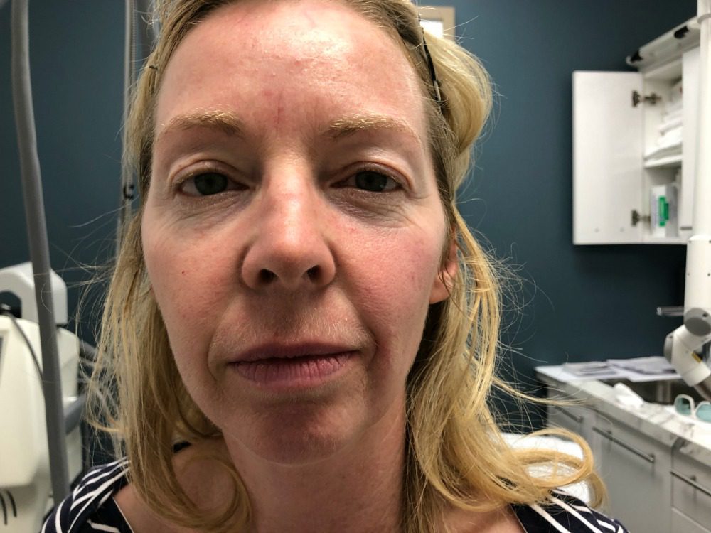 fotona laster for jowl treatment