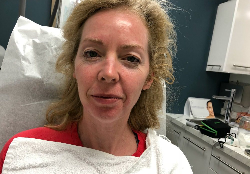 fotona laser skincare